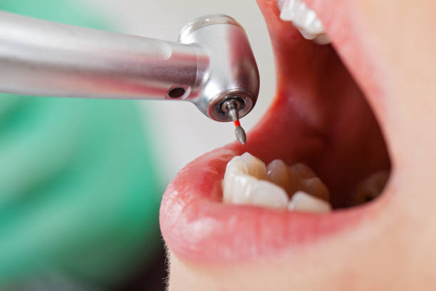 Best Knocked-Out Tooth (Avulsed Tooth) Treatment in , KS